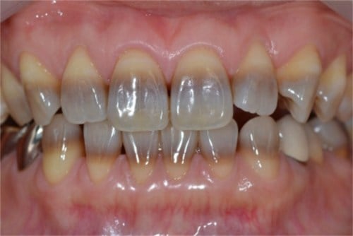Tetracycline-stains Tetracycline-stains